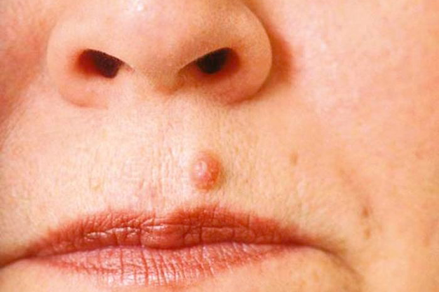 image of Basal cell carcinoma
